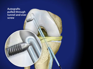 omaha ACL reconstruction