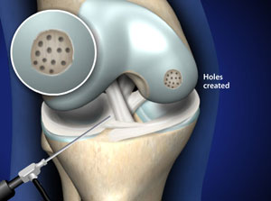 Microfracture Cartilage Restoration Procedure