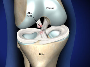 omaha torn acl