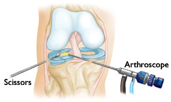 omaha knee arthroscopy surgery procedure
