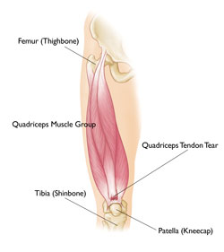 tear of the quadriceps tendon